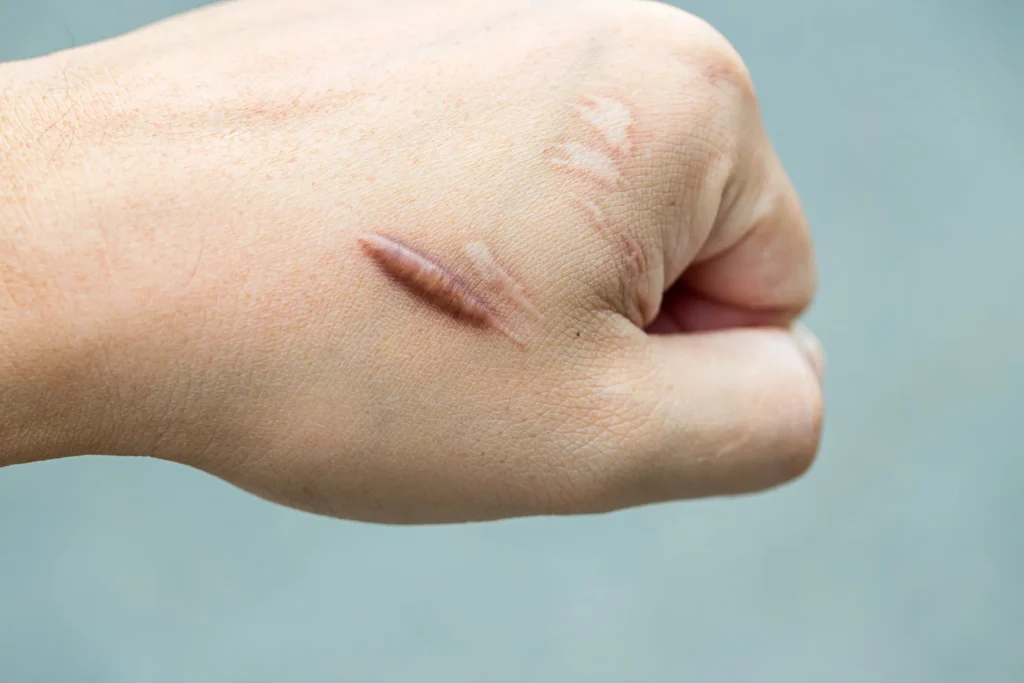 Remove Old Scars: Top 10 Medical Remedies Plus Natural Options