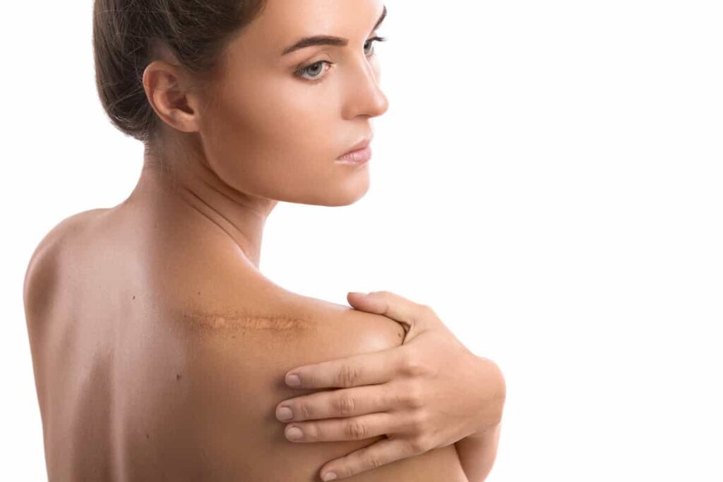 Remove Old Scars: Top 10 Medical Remedies Plus Natural Options